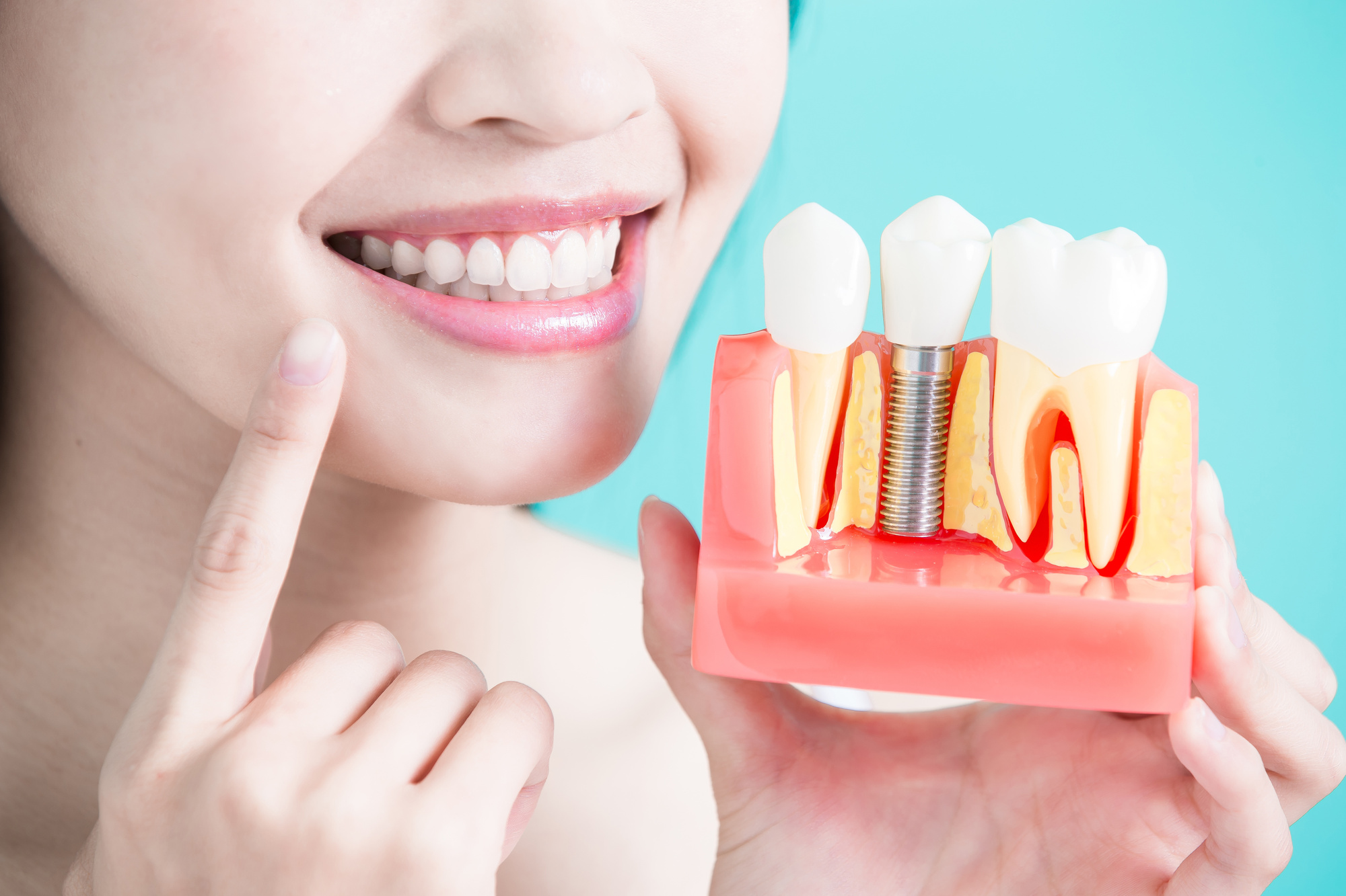 Dental implant cost near me: how much do dental implants cost? Are you thinking of undergoing the procedure? Read on to learn more.