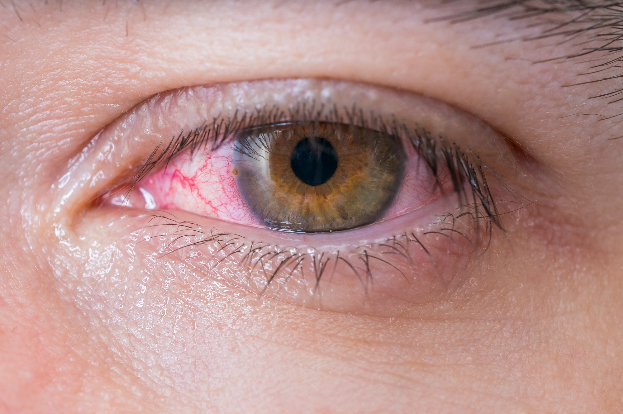 Do you want to know how to get rid of pink eye fast? Have you ever suffered from the condition? Read on to learn how to do it the right way.