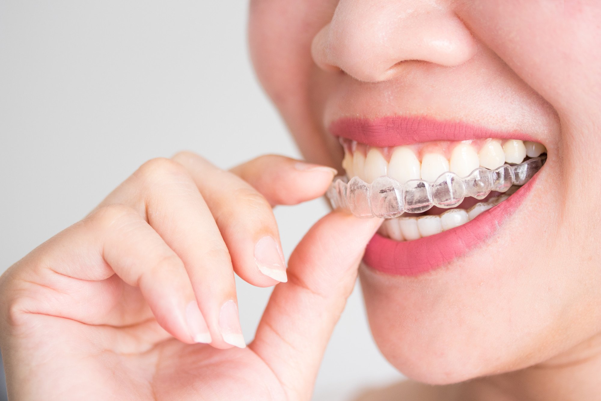 Are you familiar with Invisalign cost? This brief overview lets you learn about finding the most suitable option for your budget.