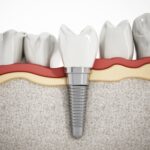 Unveil dental implant costs! Learn how much is a dental implant, considering factors that impact the investment for a confident and informed decision.