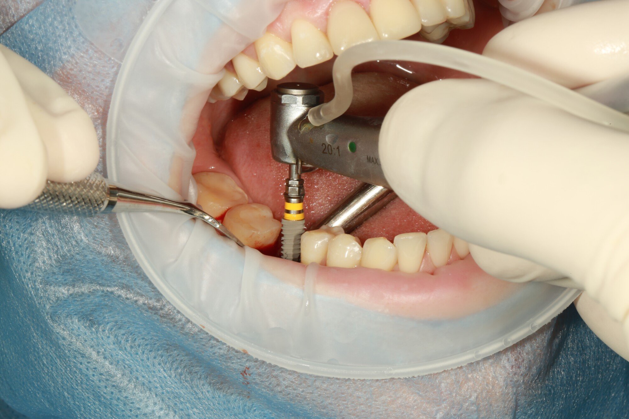 Discover the comprehensive breakdown cost of full-mouth dental implants. Unveil the inclusions and expenses associated with this transformative procedure.